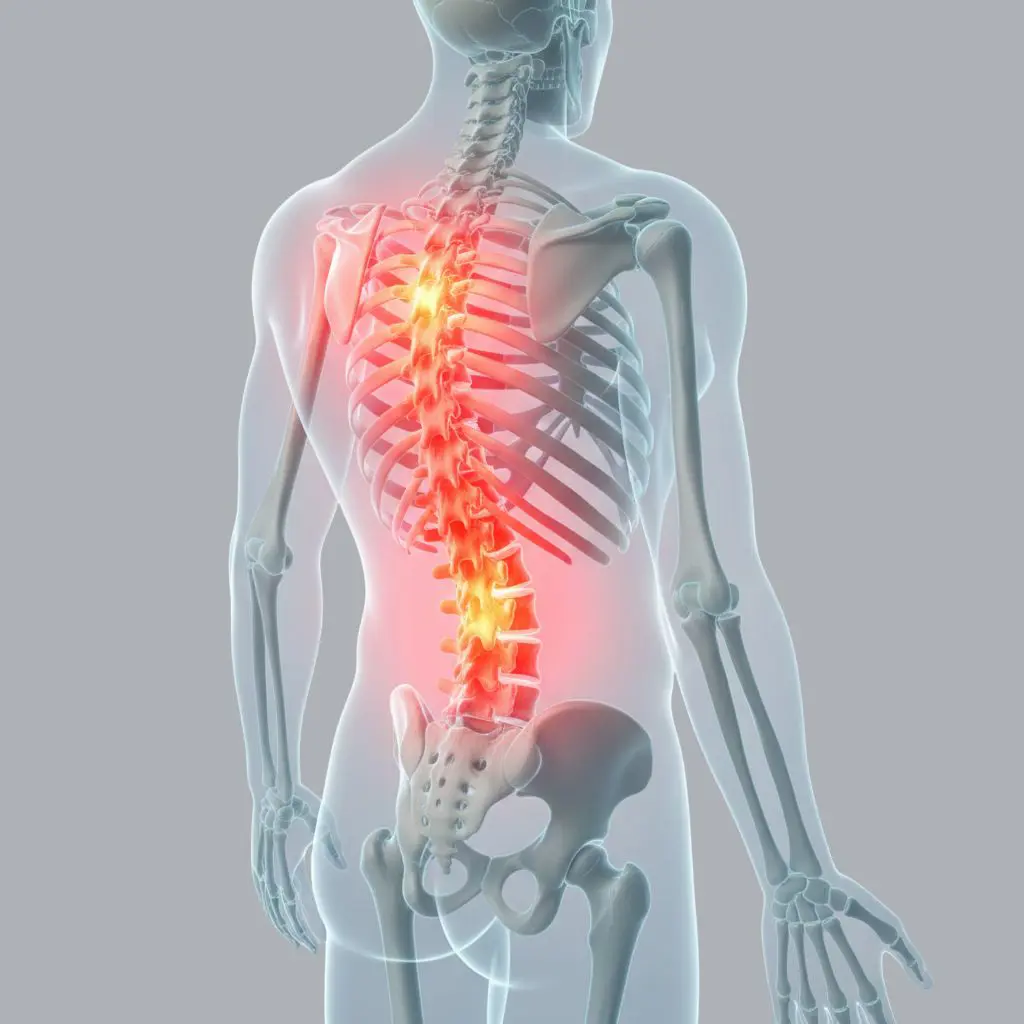 Ілюстрація остеопорозу